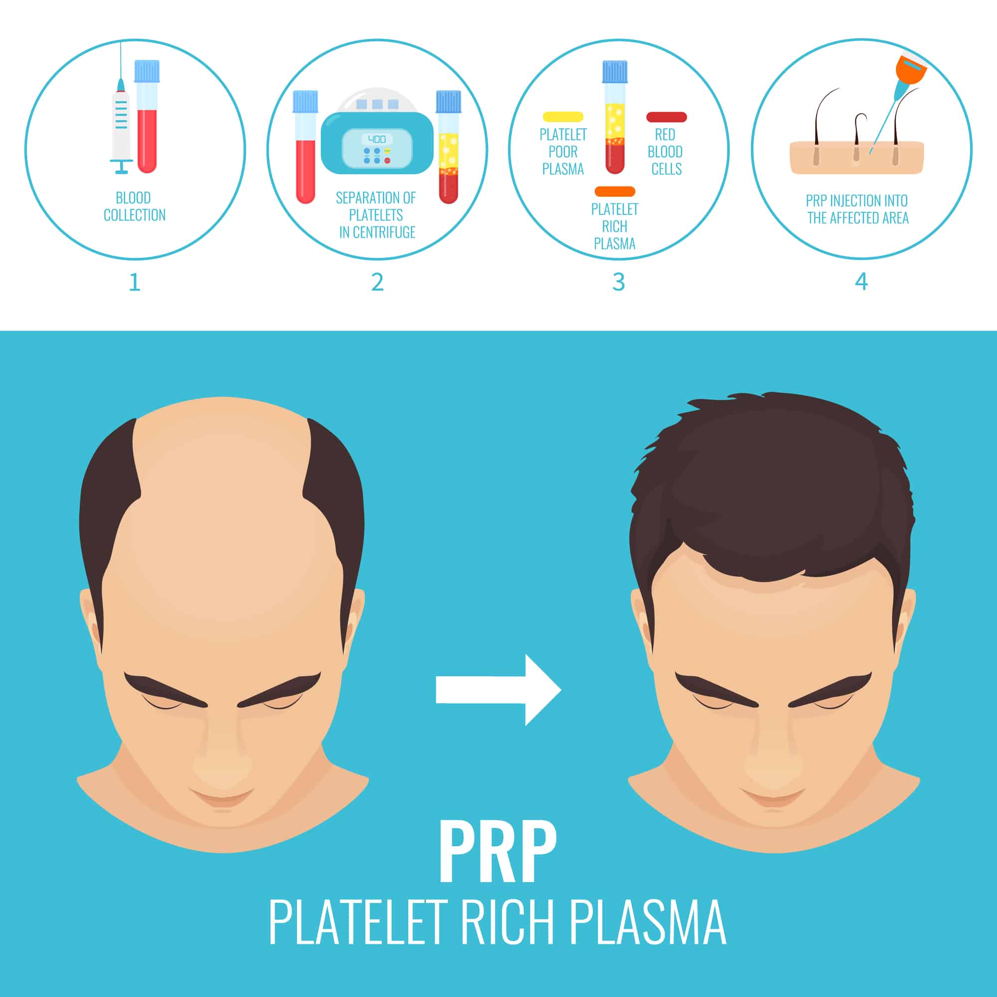 Is PRP Right For You? - Platelet Rich Plasma - AZ Hiar Restoration