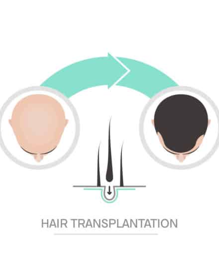 Ask a Hair Transplant Clinic Before You Schedule Surgery