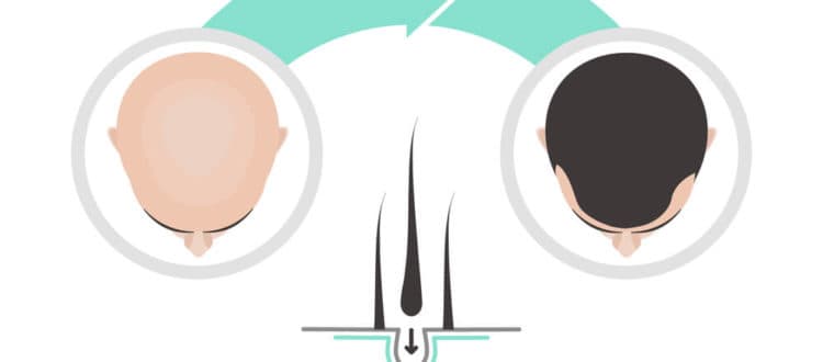 Ask a Hair Transplant Clinic Before You Schedule Surgery