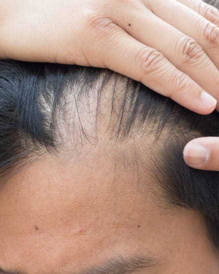 Do I Have Alopecia? Hair loss Causes & Solutions