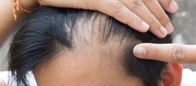 Do I Have Alopecia? Hair loss Causes & Solutions