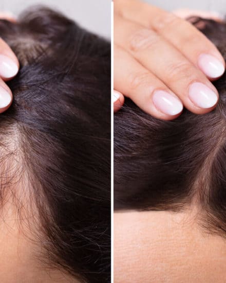 What are the costs, recovery times and potential complications of hair transplantation surgery?