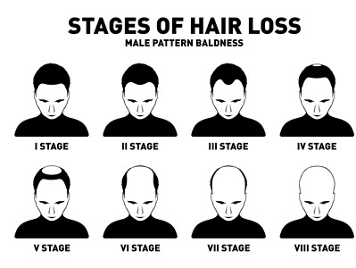 pattern baldness