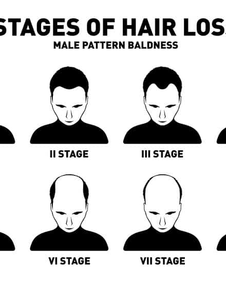 pattern baldness