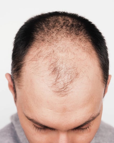 Exploring The Balding Gene Myths, Facts, And Future Possibilities