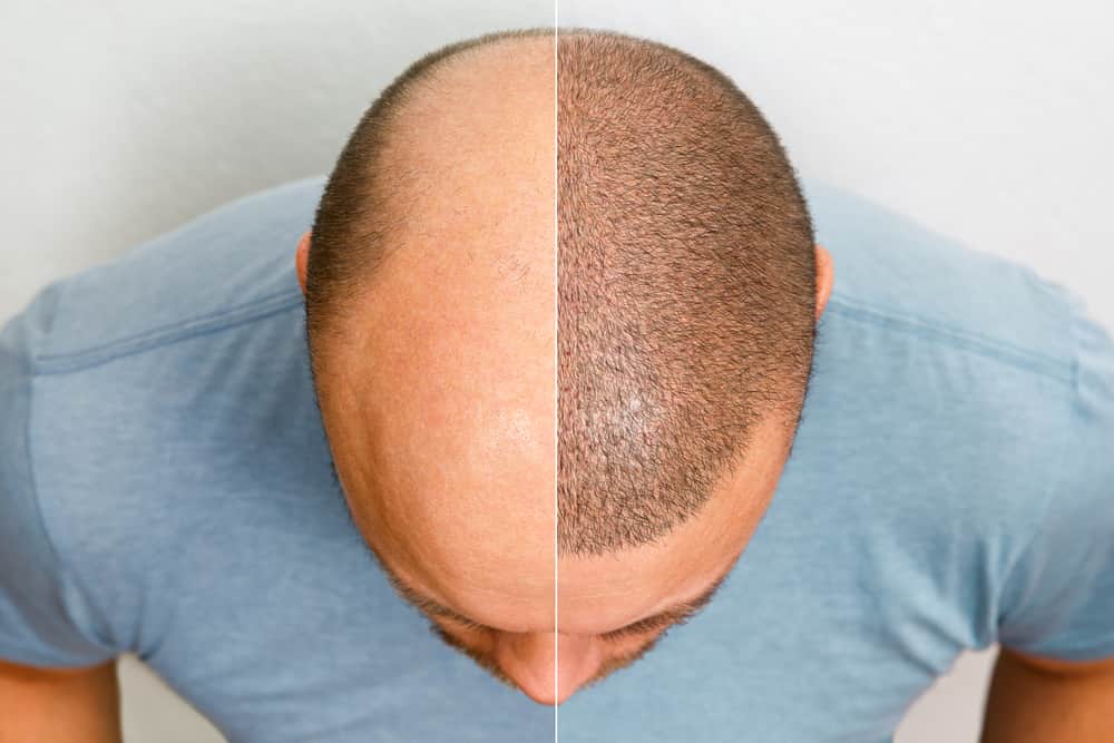 Hair Transplant Before And After A Transformative Journey